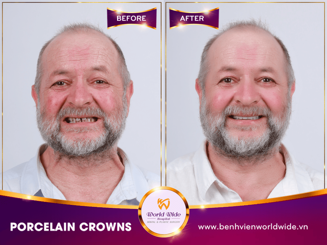 PORCELAIN CROWNS