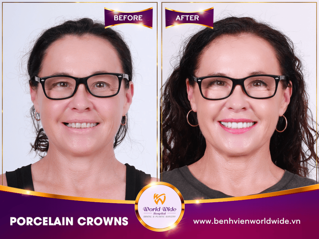DENTAL CROWNS, VENEERS & BRIDGES PORCELAIN CROWNS