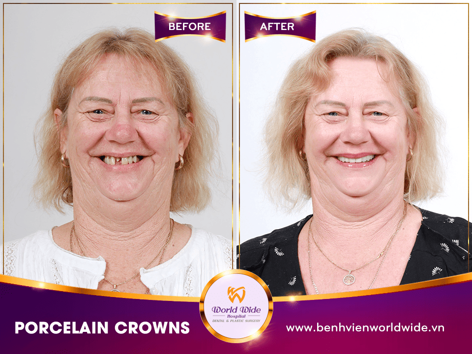 PORCELAIN CROWNS