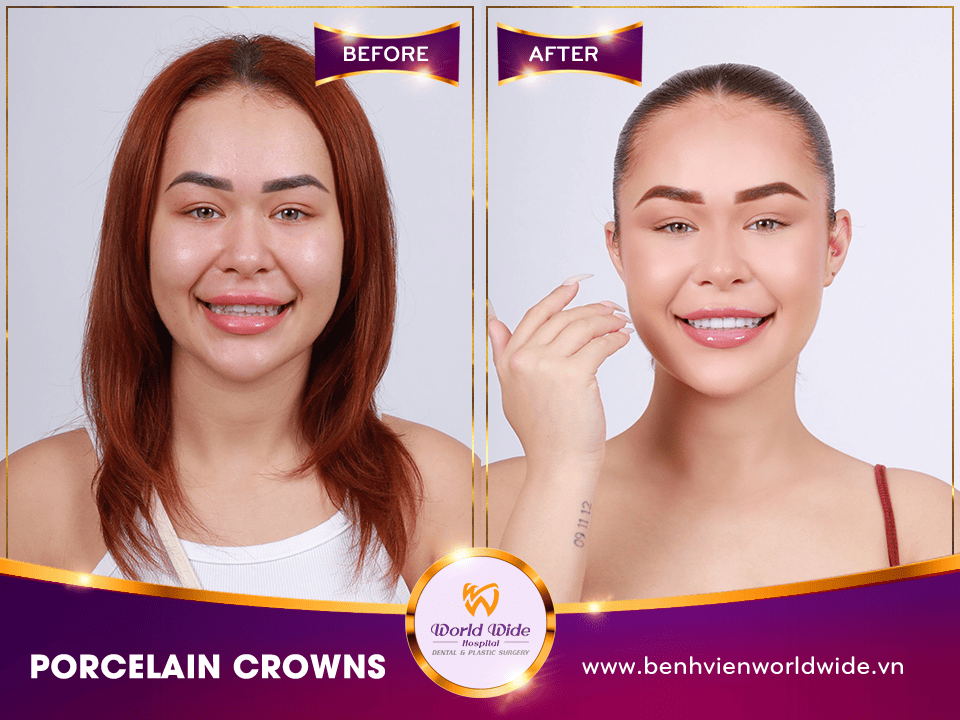 DENTAL CROWNS, VENEERS & BRIDGES PORCELAIN CROWNS