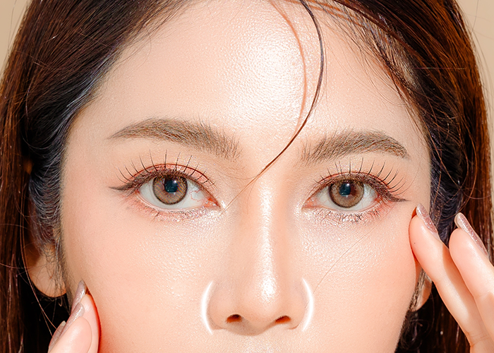 Self cartilage lifting NASAL WING REDUCTION