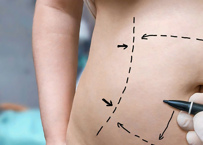 Tummy Tuck - Worldwide Hospital TUMMY TUCK