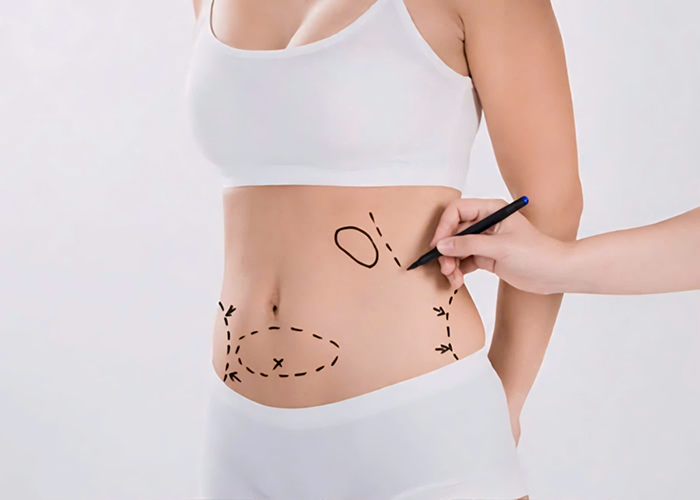 Tummy Tuck - Worldwide Hospital ULTRASONIC LIPOSUCTION