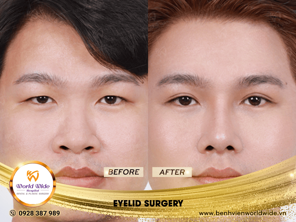 eyelid surgery