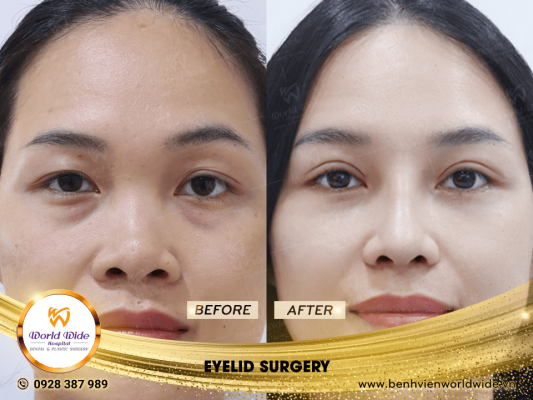 EYELID ELITE 5.0 eyelid surgery