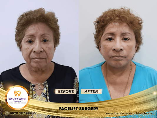 facelift surgery