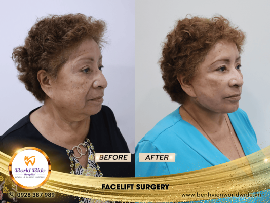 facelift surgery