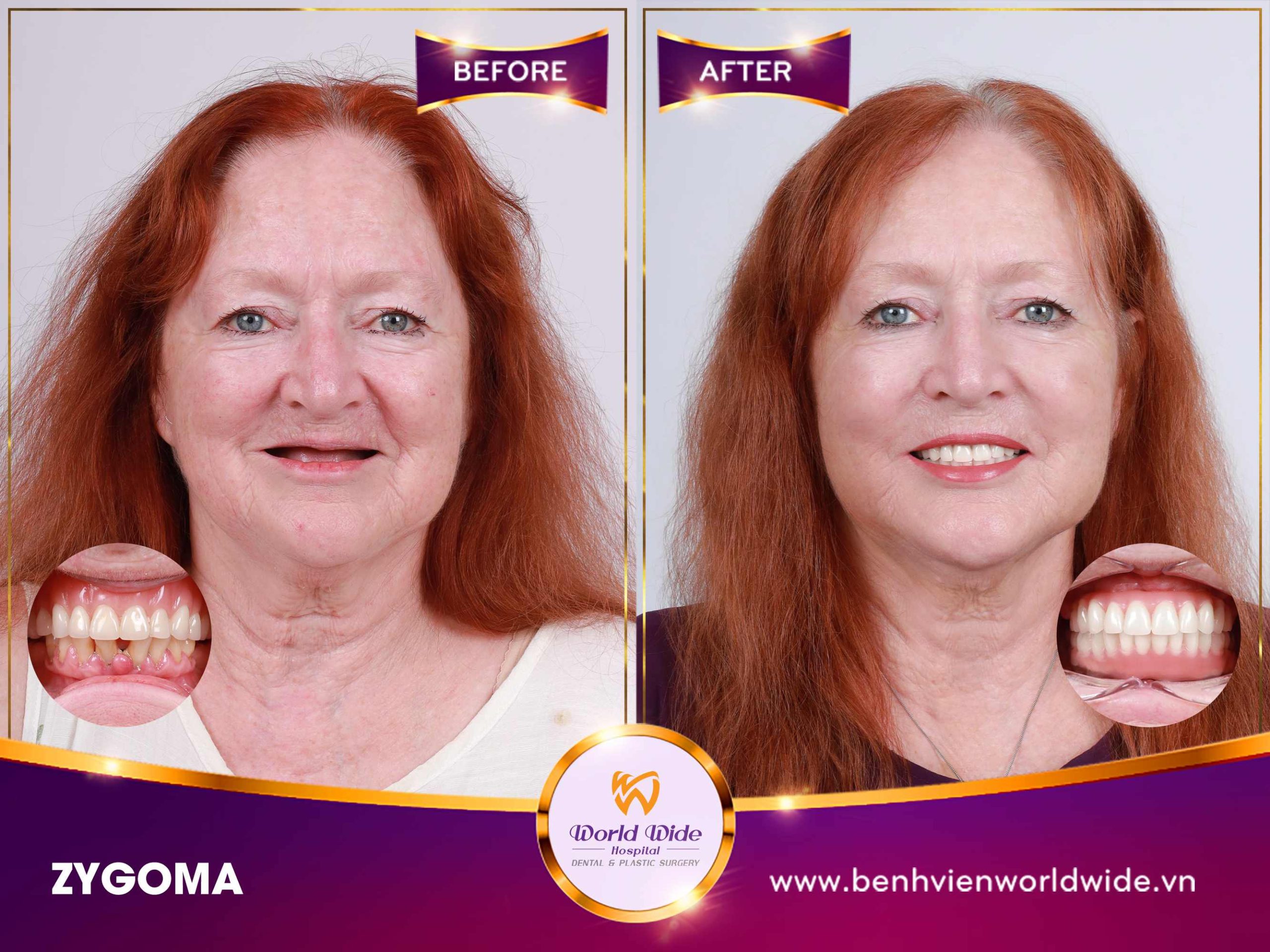 GIỚI THIỆU VỀ ZYGOMA IMPLANT IMPLANT