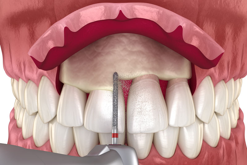 GUMMY SMILE TREATMENT - CROWN LENGTHENING VS. GUM CONTOURING CROWN LENGTHENING