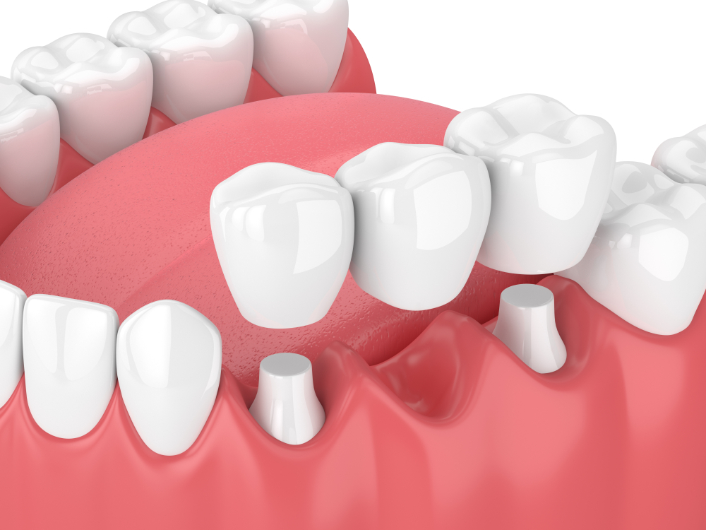 DENTAL CROWNS, VENEERS & BRIDGES DENTAL CROWNS