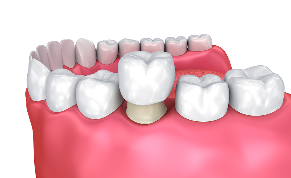 DENTAL CROWNS, VENEERS & BRIDGES DENTAL CROWNS