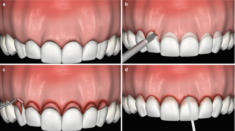 GUMMY SMILE TREATMENT - CROWN LENGTHENING VS. GUM CONTOURING GUMMY SMILE TREATMENT