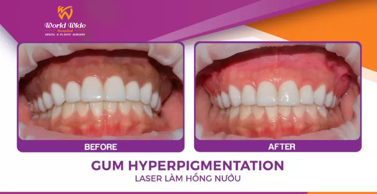 LASER-LAM-HONG-NUOU-TAI-NHA-KHOA-DR-HUNG