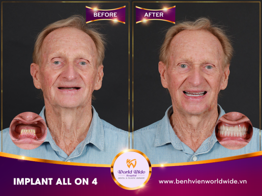 Implant Procedure Mr. Brian Wood-min
