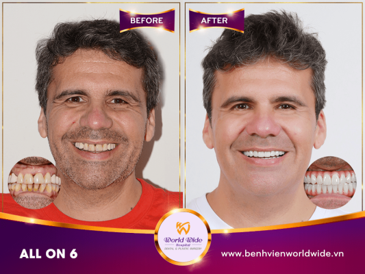 Implant Procedure Mr. Ernest Durante-min