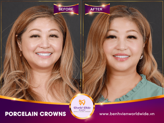 DENTAL CROWNS, VENEERS & BRIDGES DENTAL CROWNS