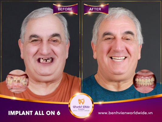 Implant Procedure SALVATORE CALCAGNO-min