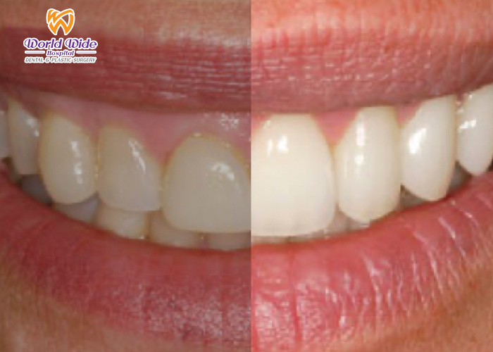 GUMMY SMILE TREATMENT - CROWN LENGTHENING VS. GUM CONTOURING WHAT IS A GUMMY SMILE