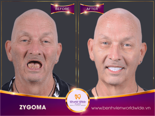 Implant Procedure ZYGOMA