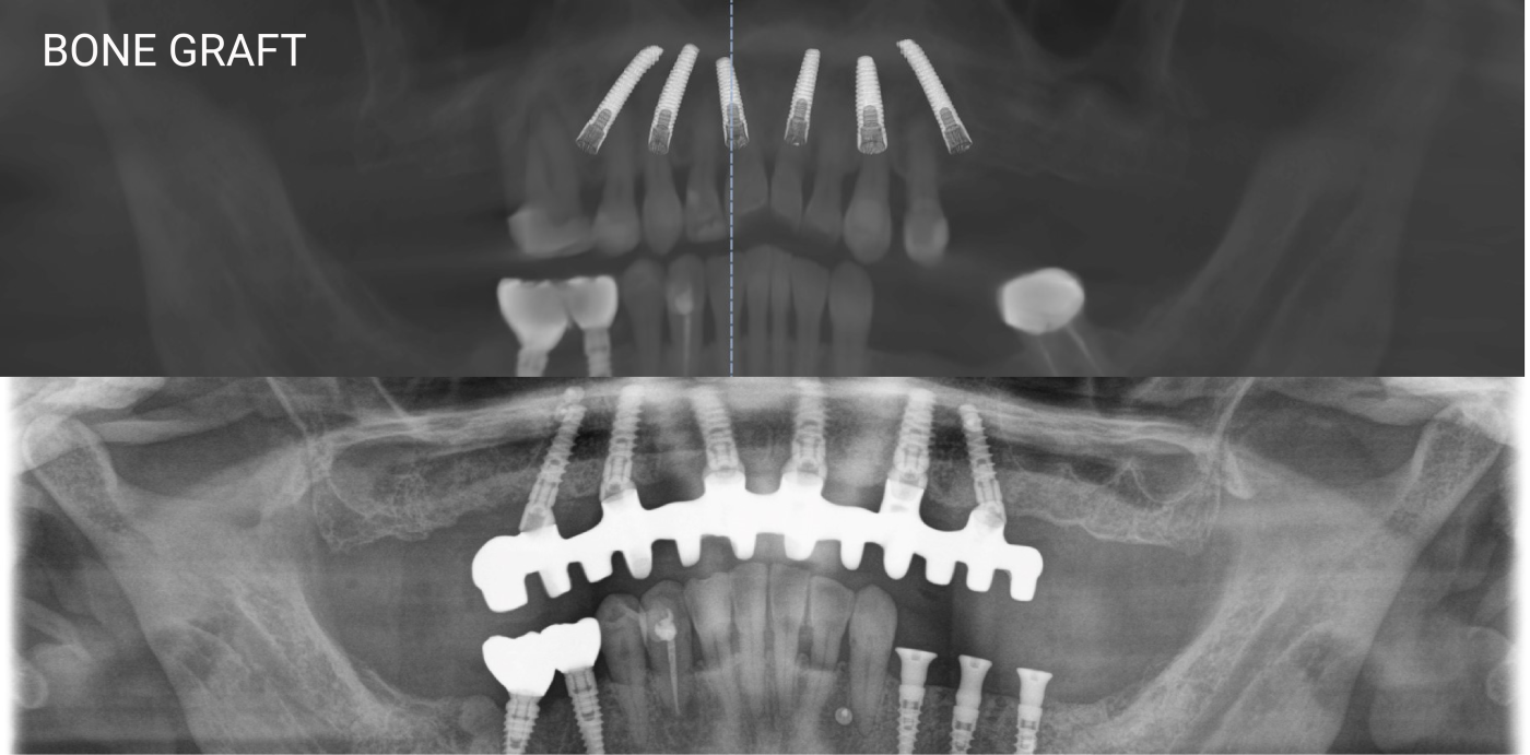 ALL-ON-4 / ALL-ON-6 bone graft