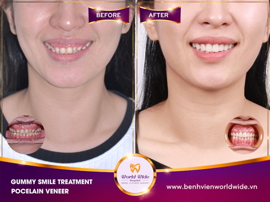 GUMMY SMILE TREATMENT - CROWN LENGTHENING VS. GUM CONTOURING GUMMY SMILE TREATMENT