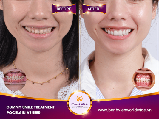 GUMMY SMILE TREATMENT - CROWN LENGTHENING VS. GUM CONTOURING GUMMY SMILE TREATMENT