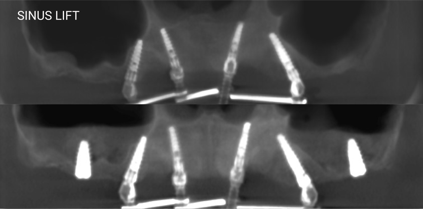 ALL-ON-4 / ALL-ON-6 sinus lift
