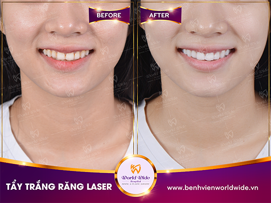 Tẩy trắng răng tẩy trắng răng