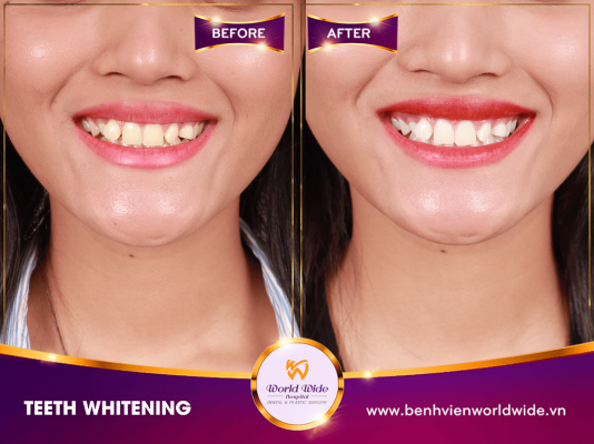 Teeth Whitening tẩy trắng răng min