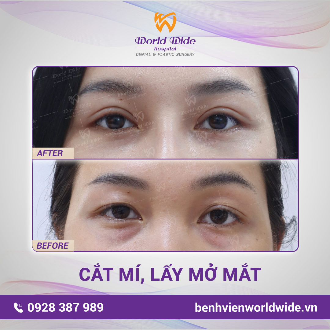 Bấm mí Elite 5.0 - Chỉ 15 phút đẹp như Sao Hàn tham my mat