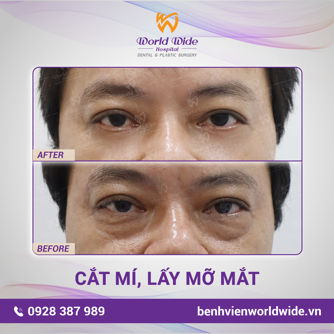 Bấm mí Elite 5.0 - Chỉ 15 phút đẹp như Sao Hàn tham my mat