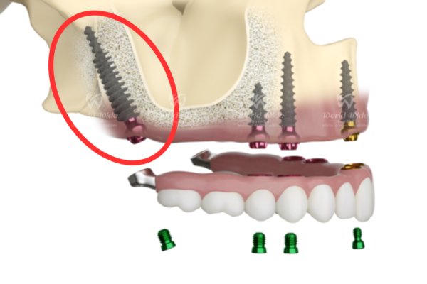 Implant chân bướm hình