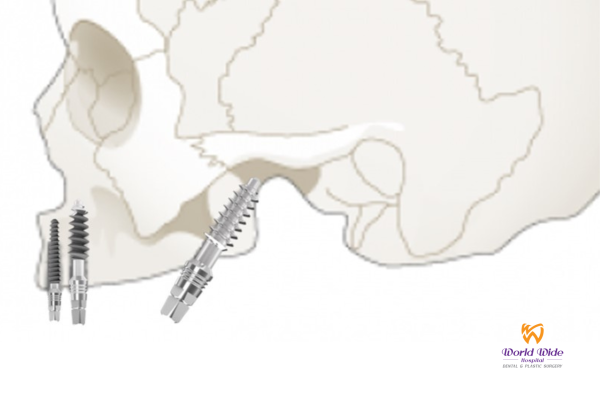 Implant chân bướm hình b3.1