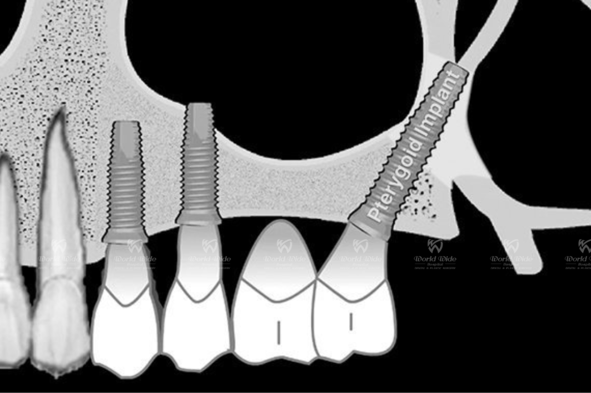 Implant chân bướm hình b3.3