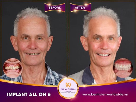 Implant Procedure implant procedure