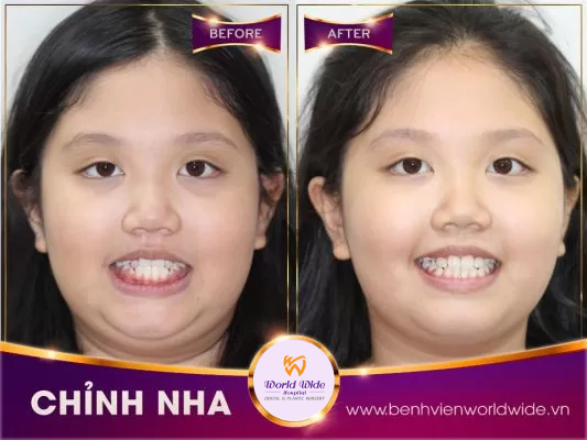 Chỉnh nha sớm tại bệnh viện Worldwide chỉnh nha sớm