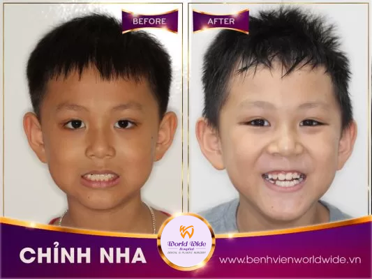 Chỉnh nha sớm tại bệnh viện Worldwide chỉnh nha sớm