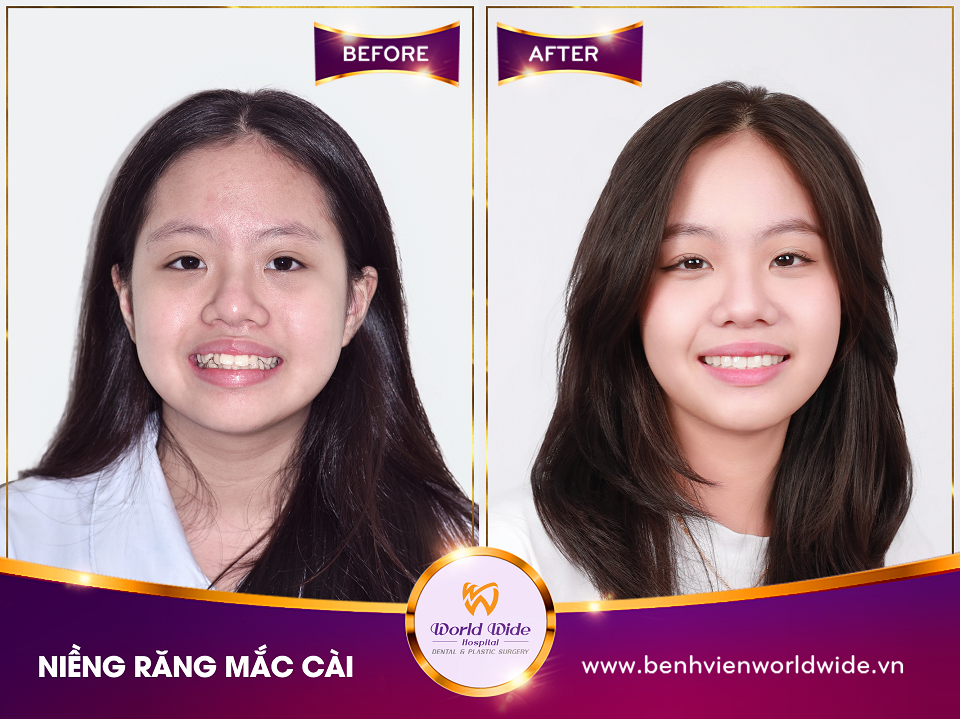 Các loại mắc cài niềng răng niềng răng mắc cài