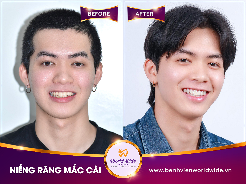 Các loại mắc cài niềng răng mắc cài niềng răng