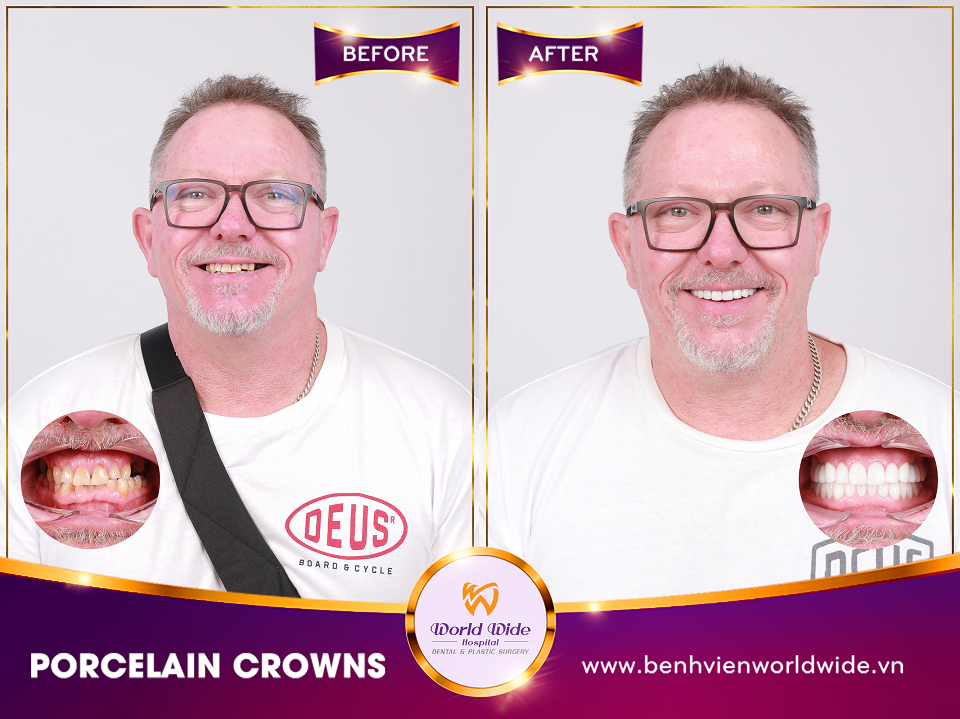 porcelain crowns BF_AT_RHM2