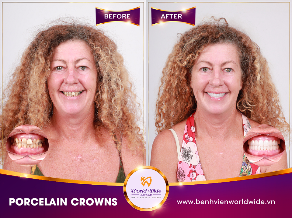 porcelain crowns BF_AT_RHM2_2