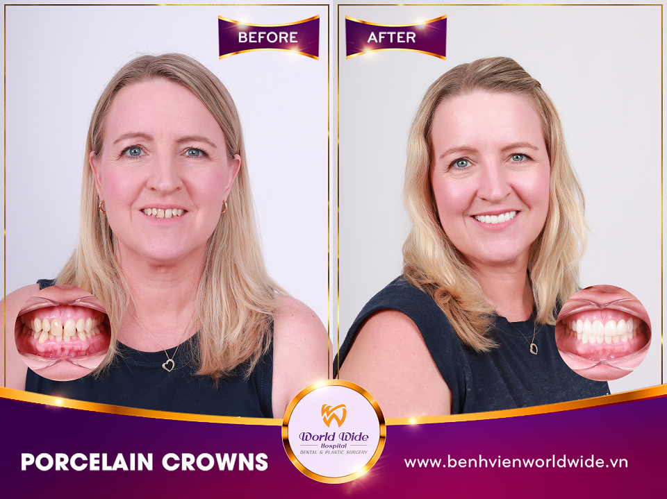 porcelain crowns Ms Tammy Bell