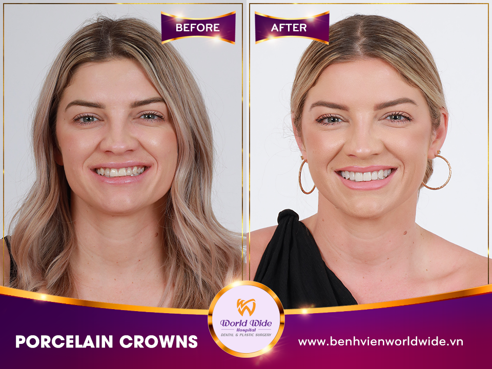 porcelain crowns Ms. Jess ley_5