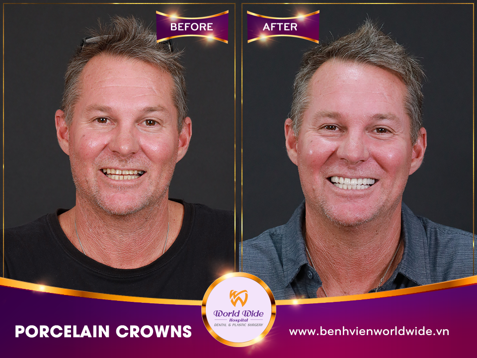 porcelain crowns PETER LEE