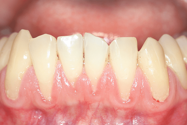Những điều cần biết về cấy ghép Implant Giúp ngăn chặn tình trạng tiêu xương, tụt lợi