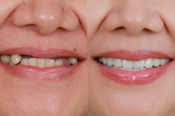 Những điều cần biết về cấy ghép Implant Giúp phục hình răng đã mất....