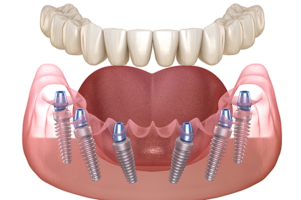 Những điều cần biết về cấy ghép Implant