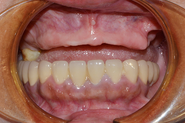 Những điều cần biết về cấy ghép Implant Mất răng