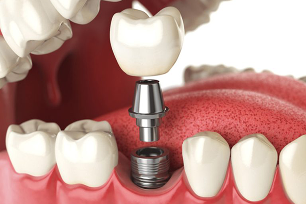Những điều cần biết về cấy ghép Implant THÔNG THƯỜNG CẤY GHÉP IMPLANT
