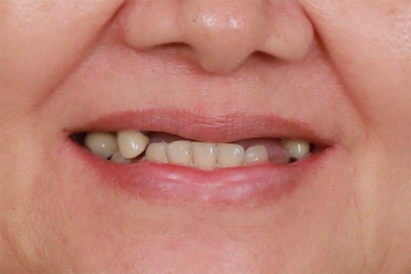 Những điều cần biết về cấy ghép Implant Trên hàm răng có một...